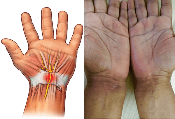 Non Invasive Carpal Tunnel Surgery Ibusiness Angel